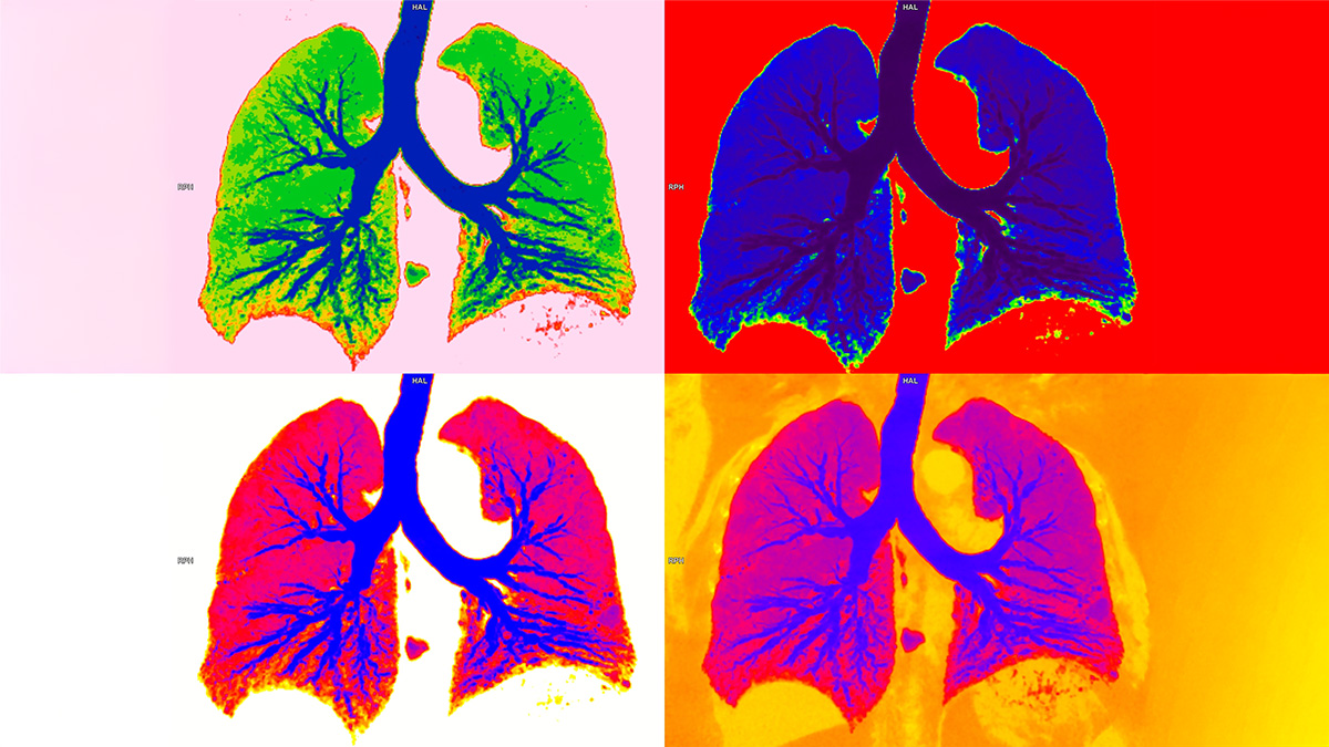 Logo der CME Fortbildung "Bronchiektasen - Antiinflammatorische Therapieoptionen und Impfprophylaxe"