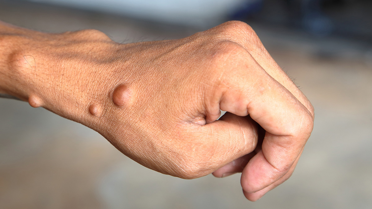 Teaserbild zum CME: NF1 im Erwachsenenalter – Viele Anzeichen und dennoch unerkannt?