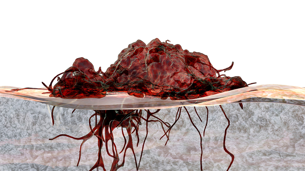 Logo der CME Fortbildung "Metastasiertes kolorektales Karzinom - Neues zur Erhaltungstherapie"