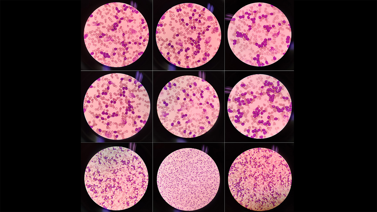 Logo der CME Fortbildung "CLL – Aktuelle Empfehlungen: Was ist neu in den Leitlinien?"