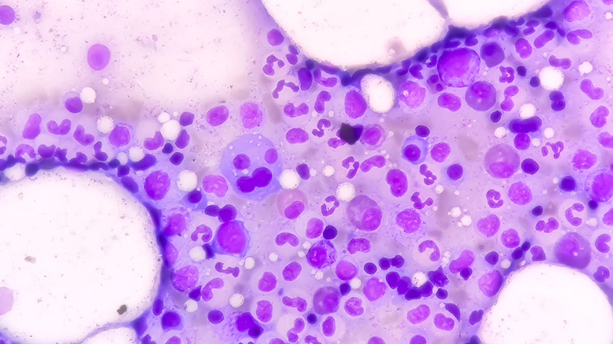 Teaserbild zum CME: Smoldering Myelom – Richtig erkennen, kontrollieren und behandeln