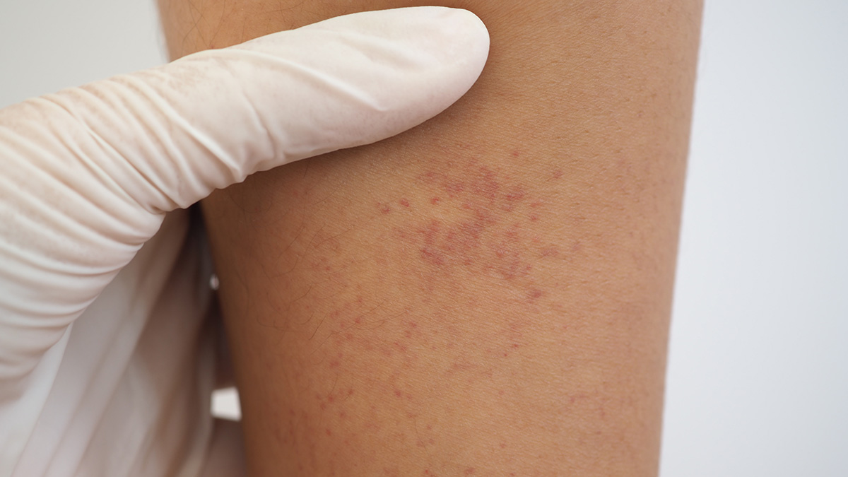 Logo der CME Fortbildung "Neues zur Immunthrombozytopenie (ITP) - Steroidtherapie & Leitlinie 2024"