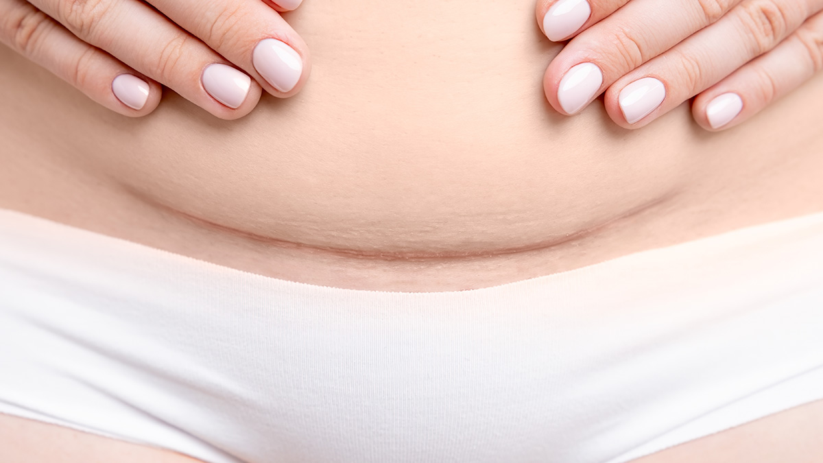 Teaserbild zum CME: Langzeitfolgen nach Kaiserschnitt: Adhäsionsmanagement und klinische Herausforderungen