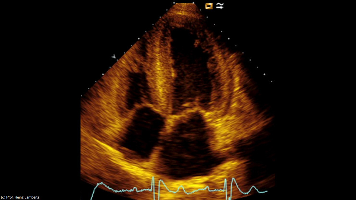 Logo der CME Fortbildung "HFpEF, Aortenstenose, Kardiale Dekompensation: Diagnostische Verdachtsmomente für eine kardiale Amyloidose"
