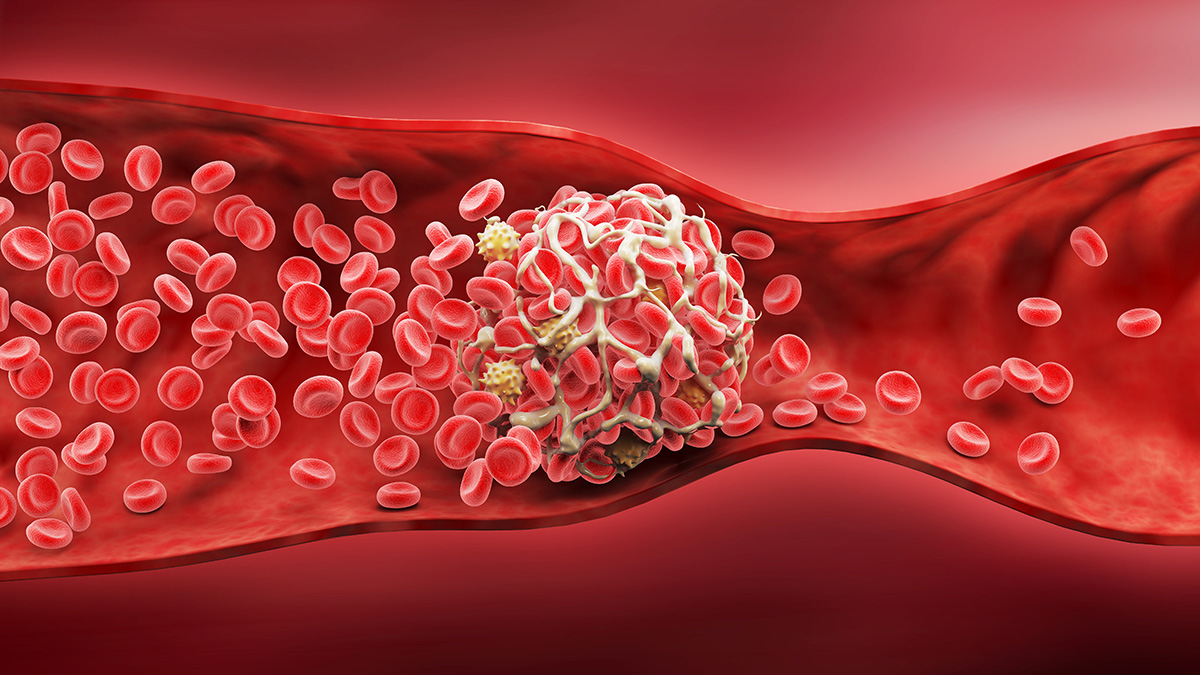 Logo der CME Fortbildung "Thromboseprophylaxe: neue Leitline 2026"