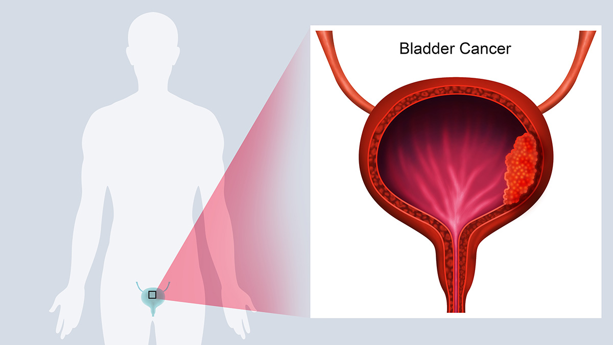 Logo der CME Fortbildung "Muskelinvasives Blasenkarzinom (MIBC) – Aktuelle und neue Therapieoptionen"
