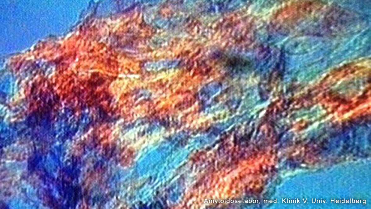 Teaserbild zum CME: AL-Amyloidose - Frühdiagnose