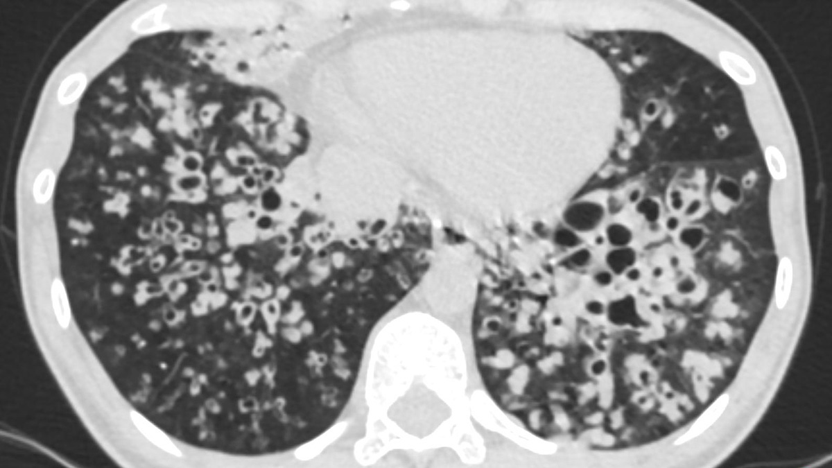 Logo der CME Fortbildung "Bronchiektasen – Radiologische Diagnose, Differentialdiagnose und Verlaufskontrolle"