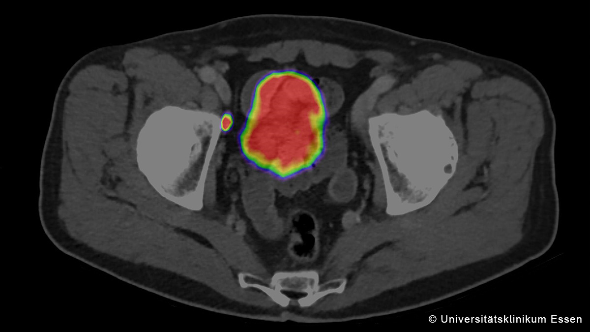 Teaserbild zum CME: Theranostik in der Nuklearmedizin am Beispiel des Prostatakarzinoms
