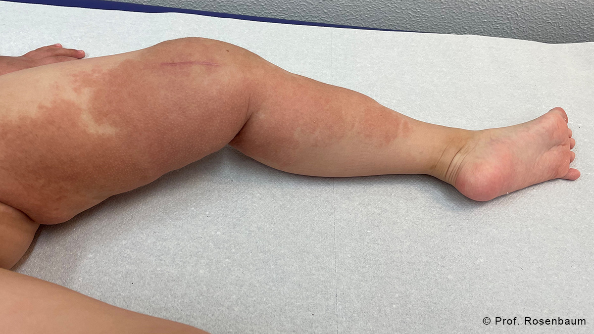Teaserbild zum CME: Therapiemanagement plexiformer Neurofibrome bei NF1 