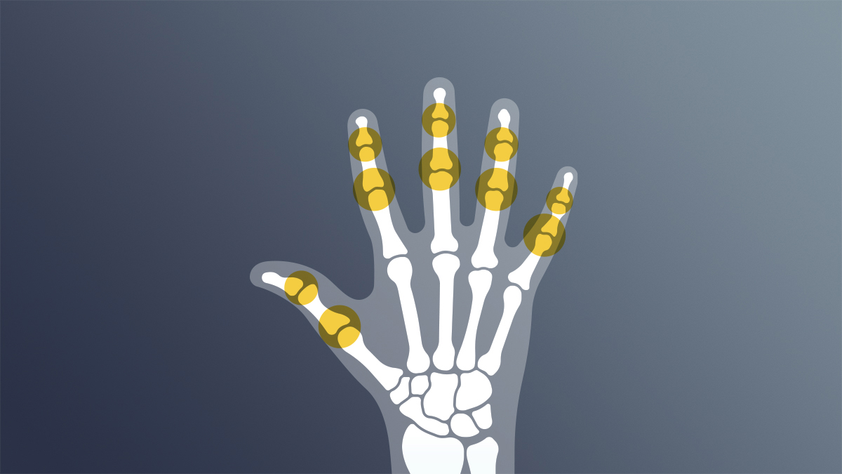 Logo der CME Fortbildung "Verlaufsformen und Krankheitsaktivitäten bei Psoriasis-Arthritis"