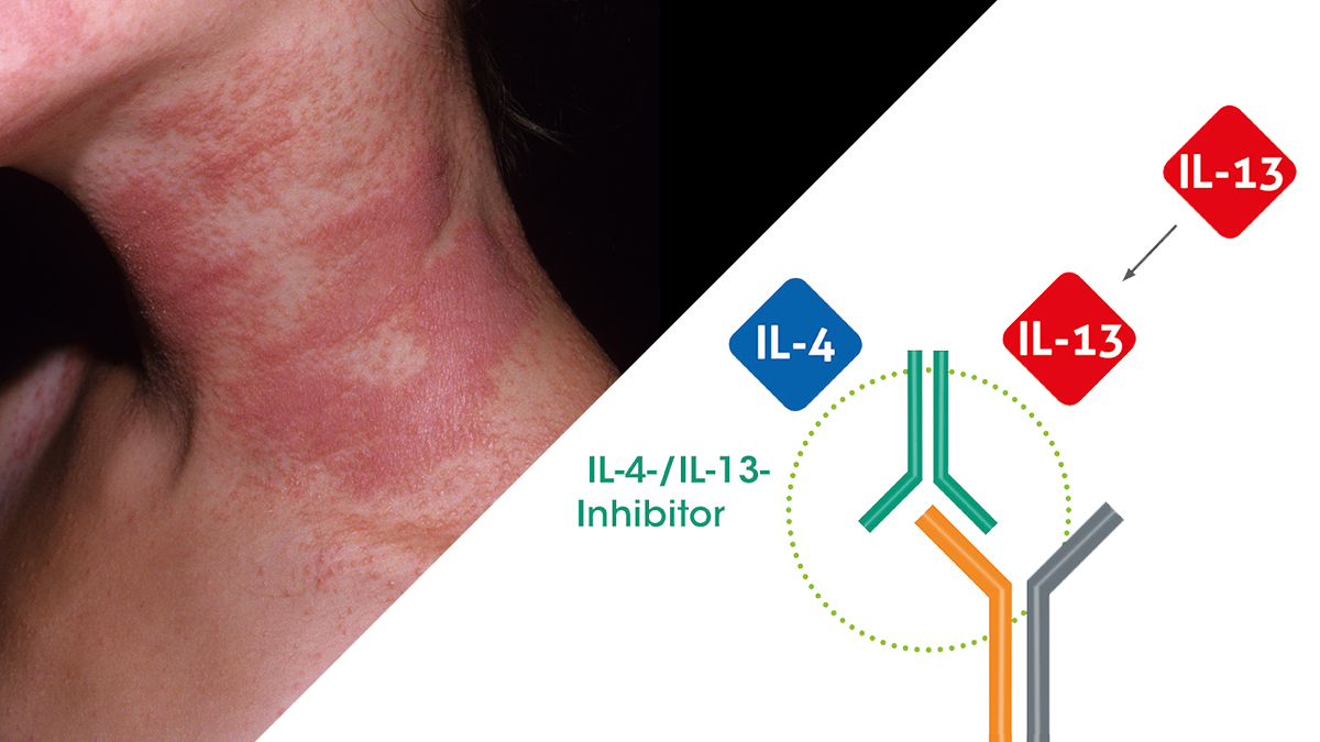 Logo der CME Fortbildung "Atopische Dermatitis – Update zum Krankheitsbild und neuen Therapien"
