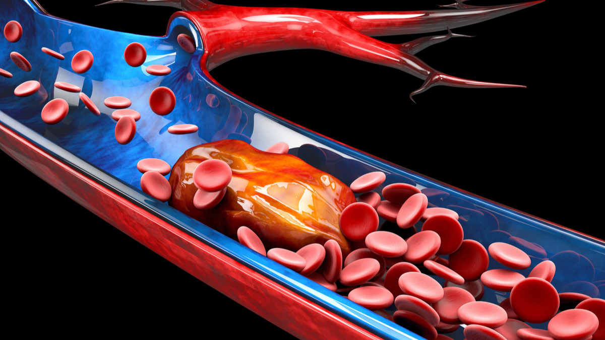 Logo der CME Fortbildung "Angiologisches Update über venöse Thromboembolie (VTE): Diagnostik, Studiendaten und Therapieoptionen
sowie Patientenfälle"