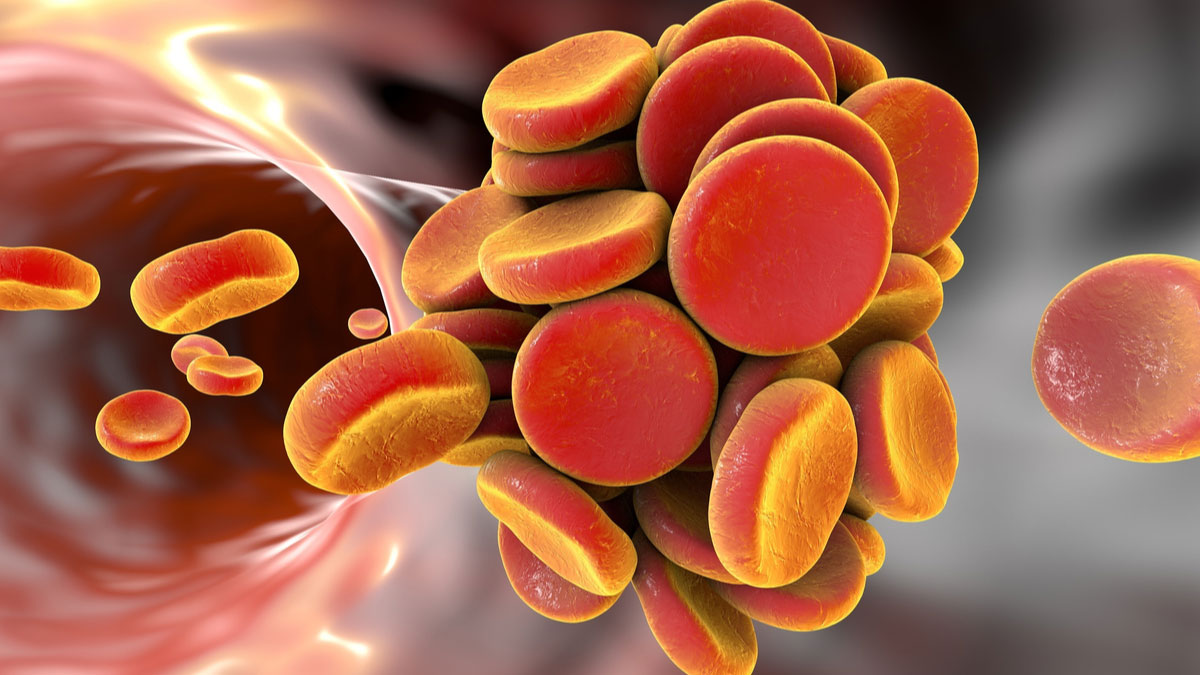 Logo der CME Fortbildung "Therapie tumorassoziierter venöser Thromboembolien"