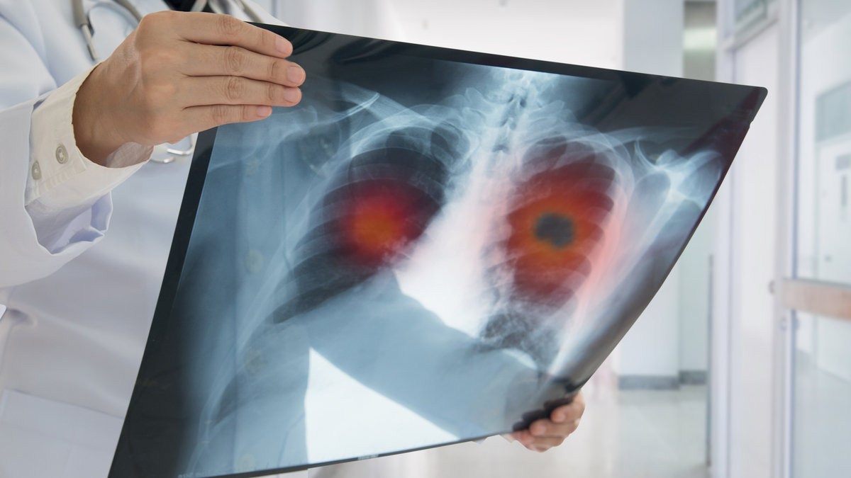 Logo der CME Fortbildung "Das fortgeschrittene ALK-mutierte NSCLC: Studien und Therapie"