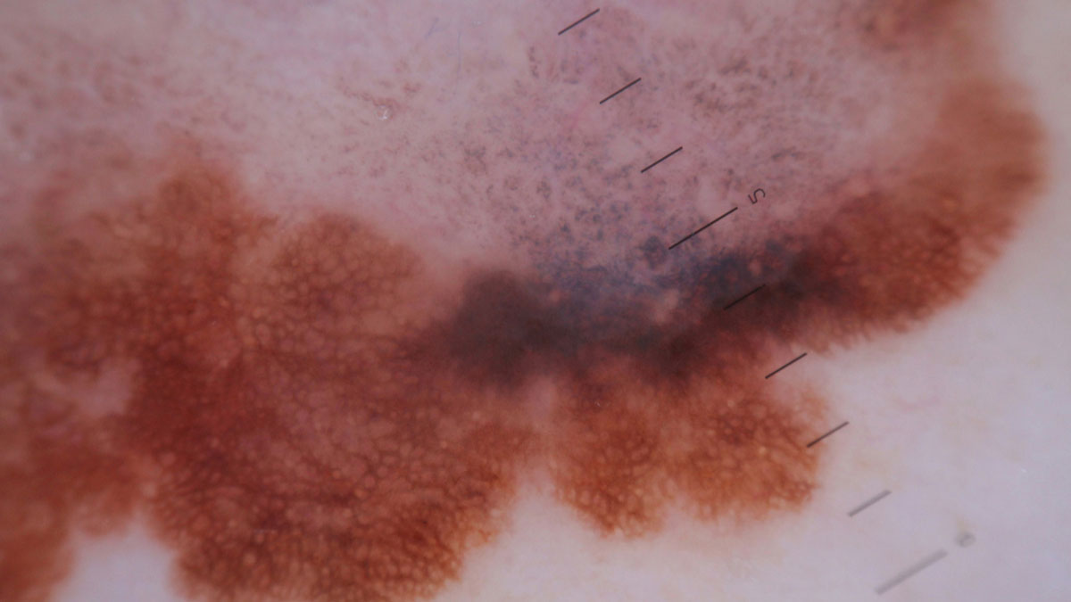 Logo der CME Fortbildung "Neues zur Melanomtherapie vom ESMO 2018"